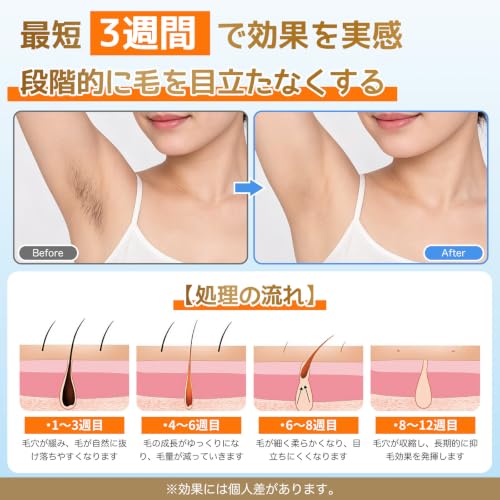 脱毛器 VIO対応【2026新登場・冷感ケア搭載】IPL光美容器 ヒゲ対応 男女兼用 高出力設計 5段階調整 自動連続照射 99万回長寿命照射 低刺激 全身対応 家庭用光脱毛器 保護メガネ・カミソリ付属の詳細・まとめ 画像